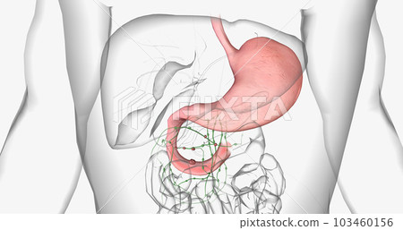 Stage III adenocarcinoma in duodenum Stage III adenocarcinoma in duodenum 103460156