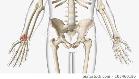 A fracture, often referred to as a broken bone, is an acute injury that causes a partial or complete break through bone. A fracture, often referred to as a broken bone, is an acute injury that causes a partial or complete break through bone. 103460180