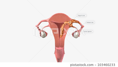 During stage III endometrial cancer, the tumor spreads outside of the uterus. 103460233