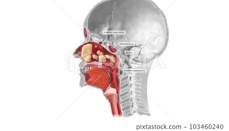The viruses cause copious amounts of thick mucus to coat the nose and throat in the infected area of the immune system. The viruses cause copious amounts of thick mucus to coat the nose and throat in the infected area of the immune system. 103460240