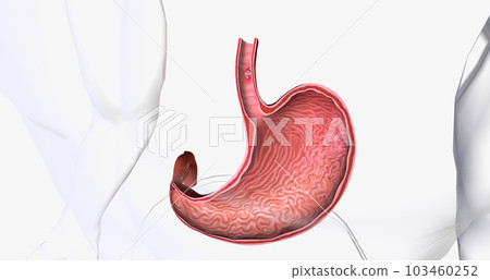 Squamous cell carcinoma, Cancer that forms in the thin, flat cells lining the inside of the esophagus. Squamous cell carcinoma, Cancer that forms in the thin, flat cells lining the inside of the esophagus. 103460252