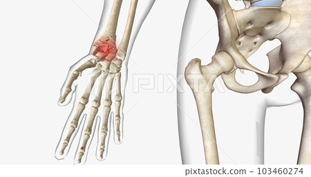 A fracture, often referred to as a broken bone, is an acute injury that causes a partial or complete break through bone. 103460274