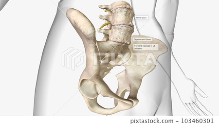 Degenerative spondylolisthesis is an orthopedic condition characterized by the forward slippage of a vertebra. 103460301