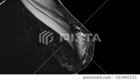 Mammography is a type of X-ray imaging technique used for the screening and diagnosis of breast cancer. Mammography is a type of X-ray imaging technique used for the screening and diagnosis of breast cancer. 103460313