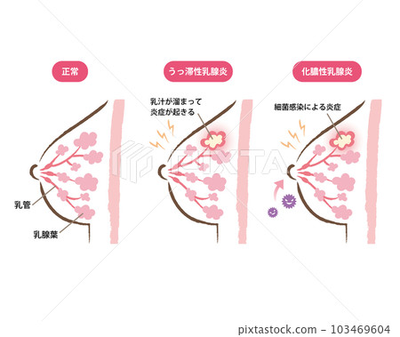 Illustration of a cross section of a mastitis bust Illustration of a cross section of a mastitis bust 103469604