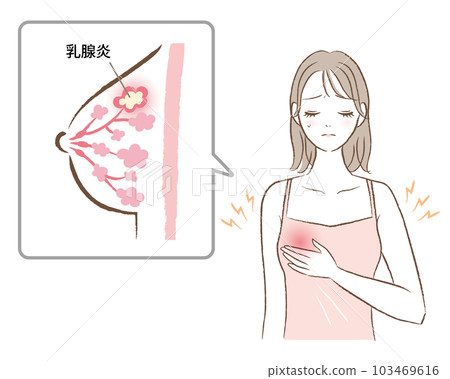 一名婦女因乳腺炎導致胸痛的插圖 103469616