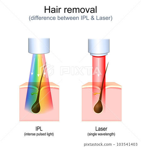 hair removal. Laser vs Intense Pulsed Light (IPL). 103541403