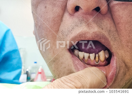 Closeup of incisor tooth that is trimed to prepare for crown to be fitted Closeup of incisor tooth that is trimed to prepare for crown to be fitted 103541691