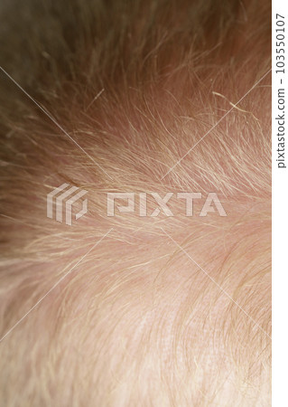 CLoseup photo of male head with hair loss problem CLoseup photo of male head with hair loss problem 103550107