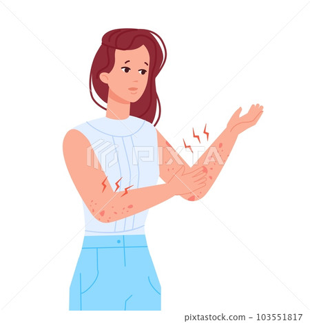 Woman scratching skin. Girl with itching elbow hand or rash on body, allergic infection itchy eczema urticaria pele atopic dermatitis symptoms, 103551817