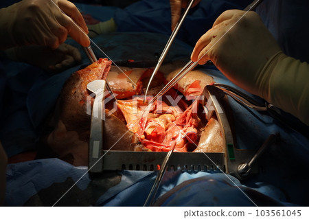 Cardio-Vascular-Thoracic surgery team wear blue coat perform heart transplant at the operating room in the hospital. 103561045