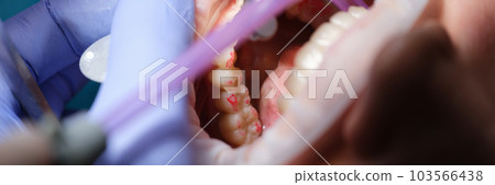 Dentist prepares woman teeth for installation of ceramic veneers and crowns using drill Dentist prepares woman teeth for installation of ceramic veneers and crowns using drill 103566438