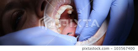 Dentist prepares female teeth for installation of ceramic veneers and crowns and removing enamel Dentist prepares female teeth for installation of ceramic veneers and crowns and removing enamel 103567400