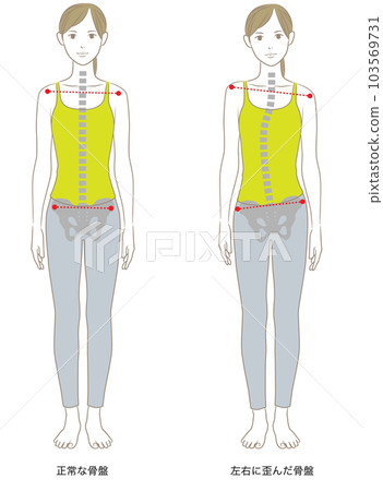 Left and right distortion of the spine and pelvis, illustration of an upright woman 103569731