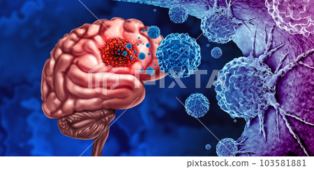Glioma Cancer Tumor Glioma Cancer Tumor 103581881