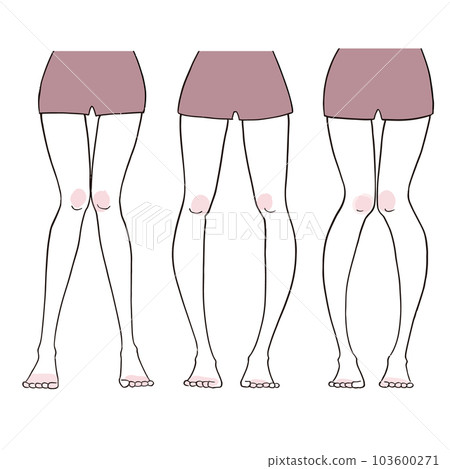 O型腿x型腿，骨盆變形 103600271