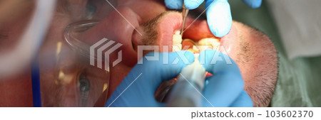 Man treats teeth in dental clinic closeup Man treats teeth in dental clinic closeup 103602370