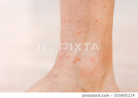 Close up allergic rash dermatitis eczema on man foot. Leg with red rash caused by insect bites. Dermatitis, folliculitis, fungal infection. Affected area of skin to turn red and blotchy and to swell 103605214
