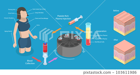 3D Isometric Flat Vector Conceptual Illustration of PRP Procedure 3D Isometric Flat Vector Conceptual Illustration of PRP Procedure 103611986
