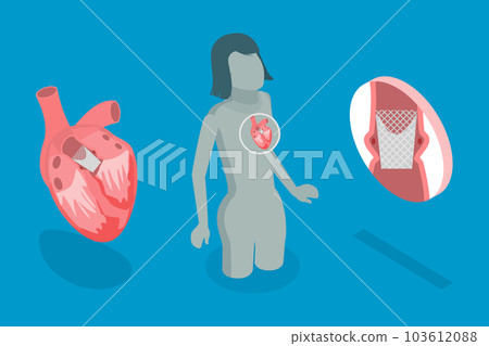 3D Isometric Flat Vector Conceptual Illustration of Transcutaneous Aortic Valve Replacement - TAVR 3D Isometric Flat Vector Conceptual Illustration of Transcutaneous Aortic Valve Replacement - TAVR 103612088