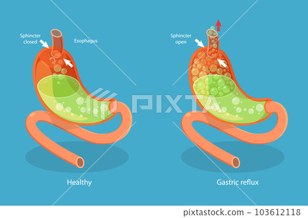 3D Isometric Flat Vector Conceptual Illustration of Stomach Reflux 103612118