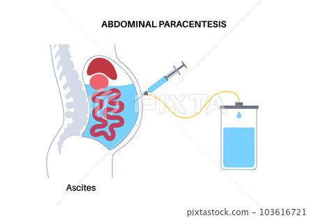 Abdominal paracentesis poster Abdominal paracentesis poster 103616721