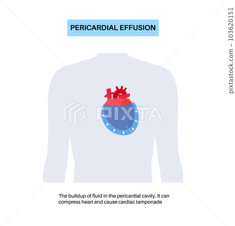 Pericardial effusion heart Pericardial effusion heart 103620151