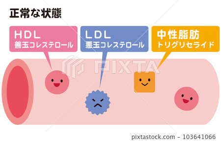 Blood vessels in normal condition and blood vessels with dyslipidemia Cholesterol Blood vessels in normal condition and blood vessels with dyslipidemia Cholesterol 103641066