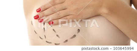 Woman breasts are marked for cosmetic surgery closeup Woman breasts are marked for cosmetic surgery closeup 103645994