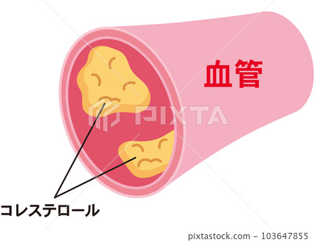 Mechanism of LDL and HDL Dyslipidemia Blood vessels Cholesterol 103647855