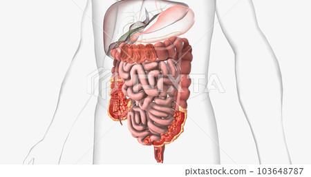 Crohns disease is a type of chronic inflammatory bowel disease. Crohns disease is a type of chronic inflammatory bowel disease. 103648787