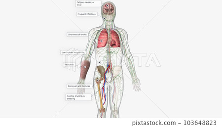 The AML, Signs and Symptoms The AML, Signs and Symptoms 103648823
