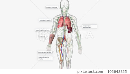 The CML, Signs and Symptoms The CML, Signs and Symptoms 103648835
