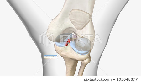Meniscal root tears are less common than meniscal body tears and frequently go undetected. Meniscal root tears are less common than meniscal body tears and frequently go undetected. 103648877
