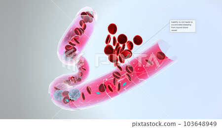 Hemophilia is a recessive genetic disorder that impairs the ability of blood to clot. Hemophilia is a recessive genetic disorder that impairs the ability of blood to clot. 103648949