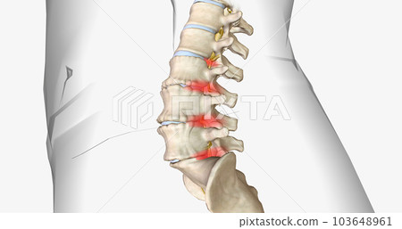 Degenerative disc disease is characterized by the gradual degeneration of the intervertebral discs. Degenerative disc disease is characterized by the gradual degeneration of the intervertebral discs. 103648961