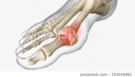 Tophi appear as multiple painless hard nodules with possible joint deformities. 103648962