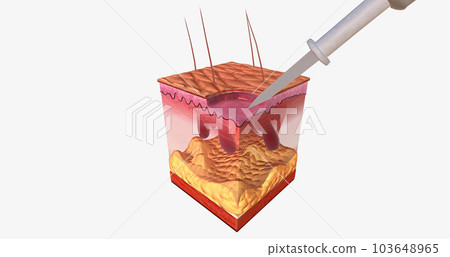 The Curettage and Electrodesiccation Close Up The Curettage and Electrodesiccation Close Up 103648965