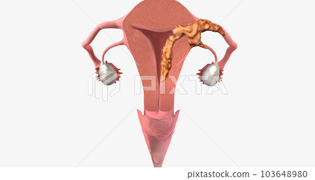 During stage III endometrial cancer, the tumor spreads outside of the uterus. 103648980