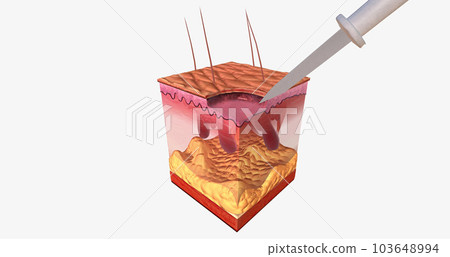 The Curettage and Electrodesiccation Close Up The Curettage and Electrodesiccation Close Up 103648994