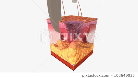 The Excisional Biopsy Close Up 103649035