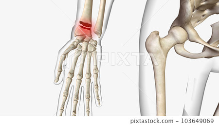 Distal radius fractures are among the most common types of fractures and are most common in the upper extremities. 103649069
