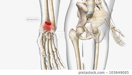 Distal radius fractures are among the most common types of fractures and are most common in the upper extremities. 103649085