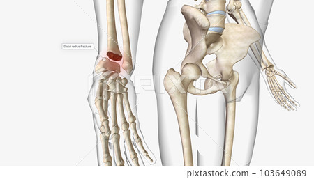 Distal radius fractures are among the most common types of fractures and are most common in the upper extremities. 103649089