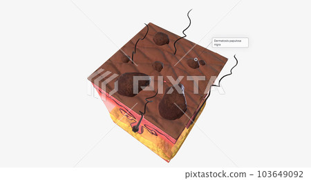 The DPN in Skin Tissue The DPN in Skin Tissue 103649092
