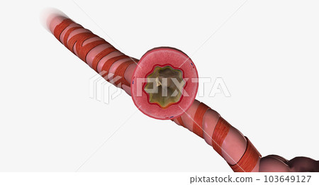It causes the muscles of the airways to swell and become inflamed, making it difficult to breathe. It causes the muscles of the airways to swell and become inflamed, making it difficult to breathe. 103649127