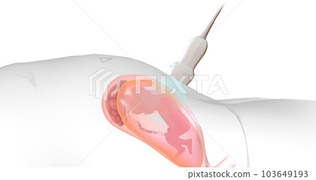 Under the guidance of the ultrasound, the needle enters the amniotic sac while avoiding the fetus. Under the guidance of the ultrasound, the needle enters the amniotic sac while avoiding the fetus. 103649193