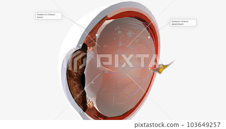 Floaters are small spots in your field of vision. Floaters are small spots in your field of vision. 103649257
