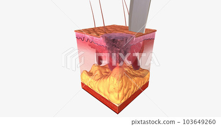 The Excisional Biopsy Close Up 103649260