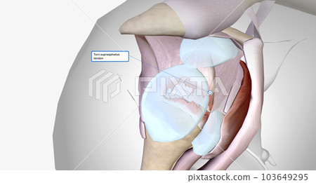 Torn rotator cuff is a musculoskeletal injury that results from damage to the rotator cuff muscles or tendons. 103649295